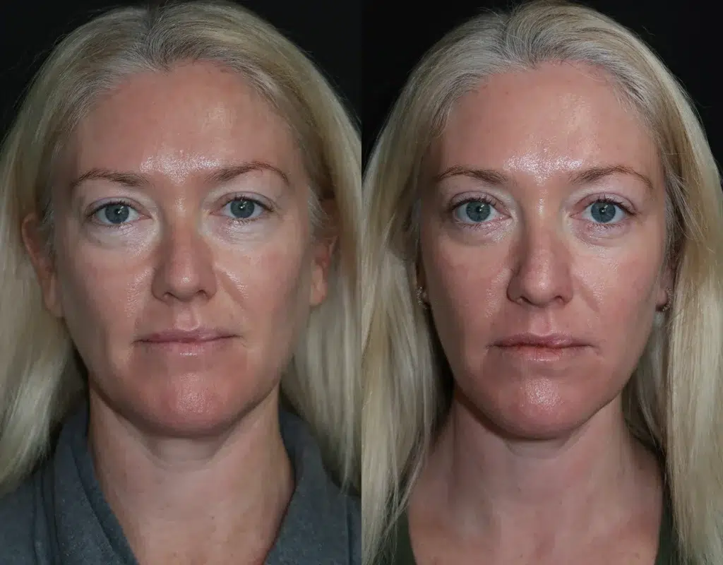 blepharoplasty with co2 before and after photo by faceology md in newport beach ca