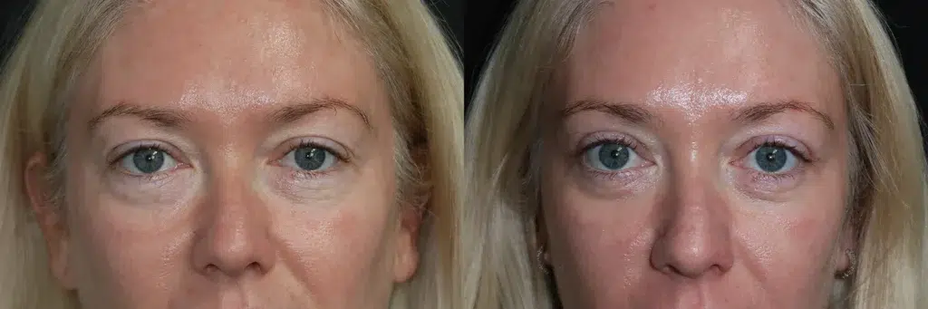 blepharoplasty with co2 before and after photo by faceology md in newport beach ca