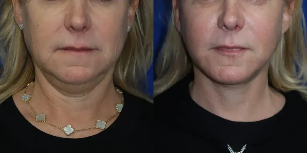 faceology lift neck lift with co2 laser before and after photo by faceology md in newport beach ca