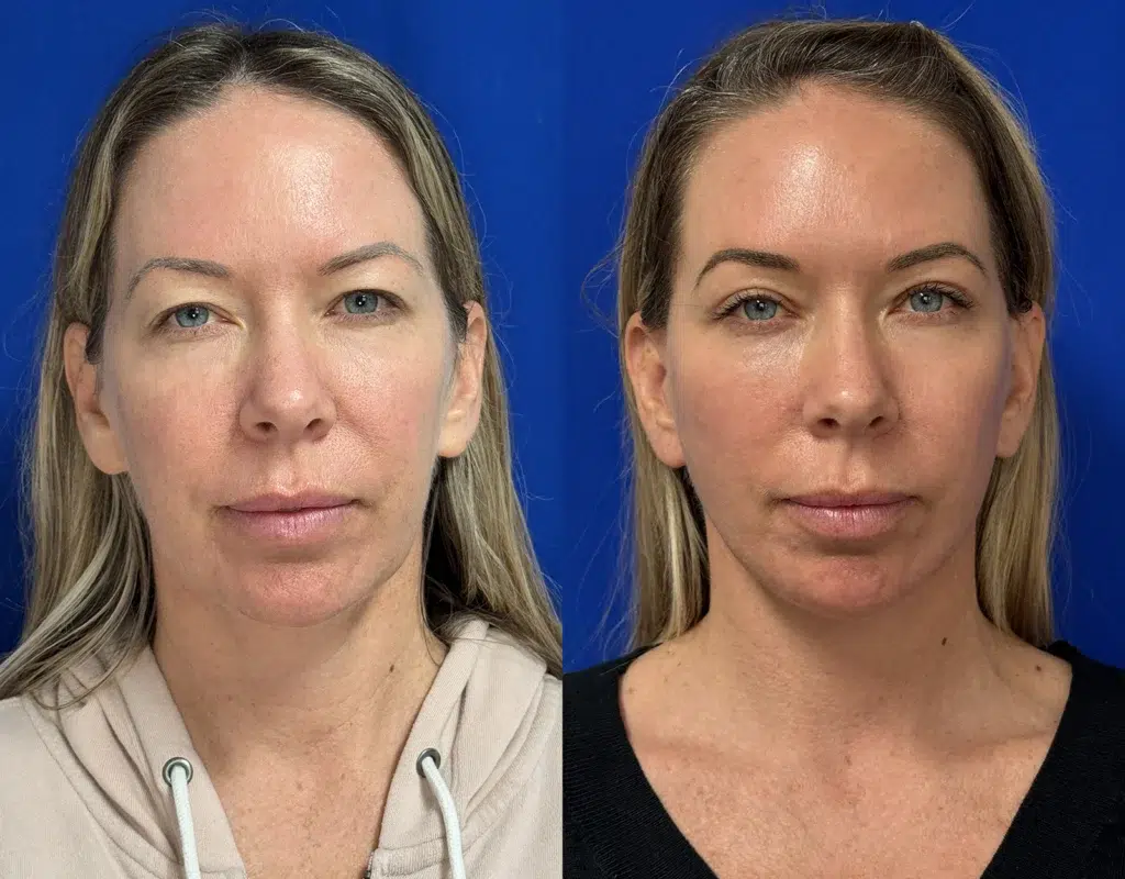 faceology lift neck lift and blepharoplasty before and after photo by faceology md in newport beach ca