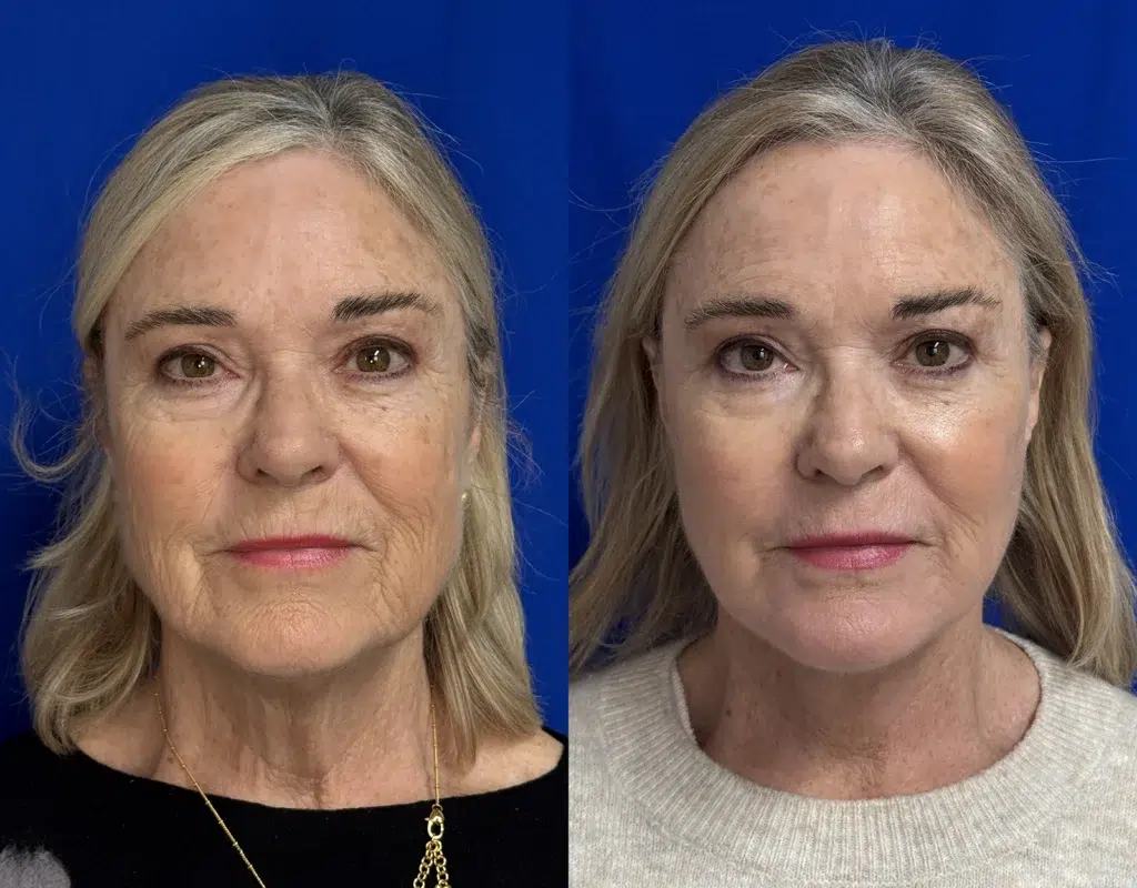 faceology lift neck lift with co2 laser before and after photo by faceology md in newport beach ca