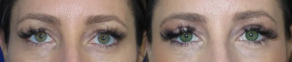 eyelid lift before and after photo by faceology md in newport beach ca