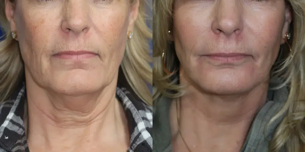 co2 laser before and after photo by faceology md in newport beach ca