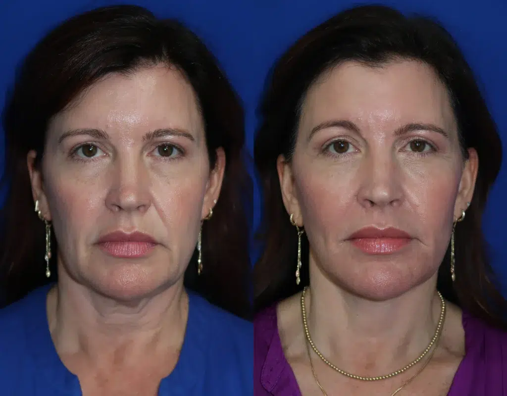 faceology lift neck Lift before and after photo by faceology md in newport beach ca