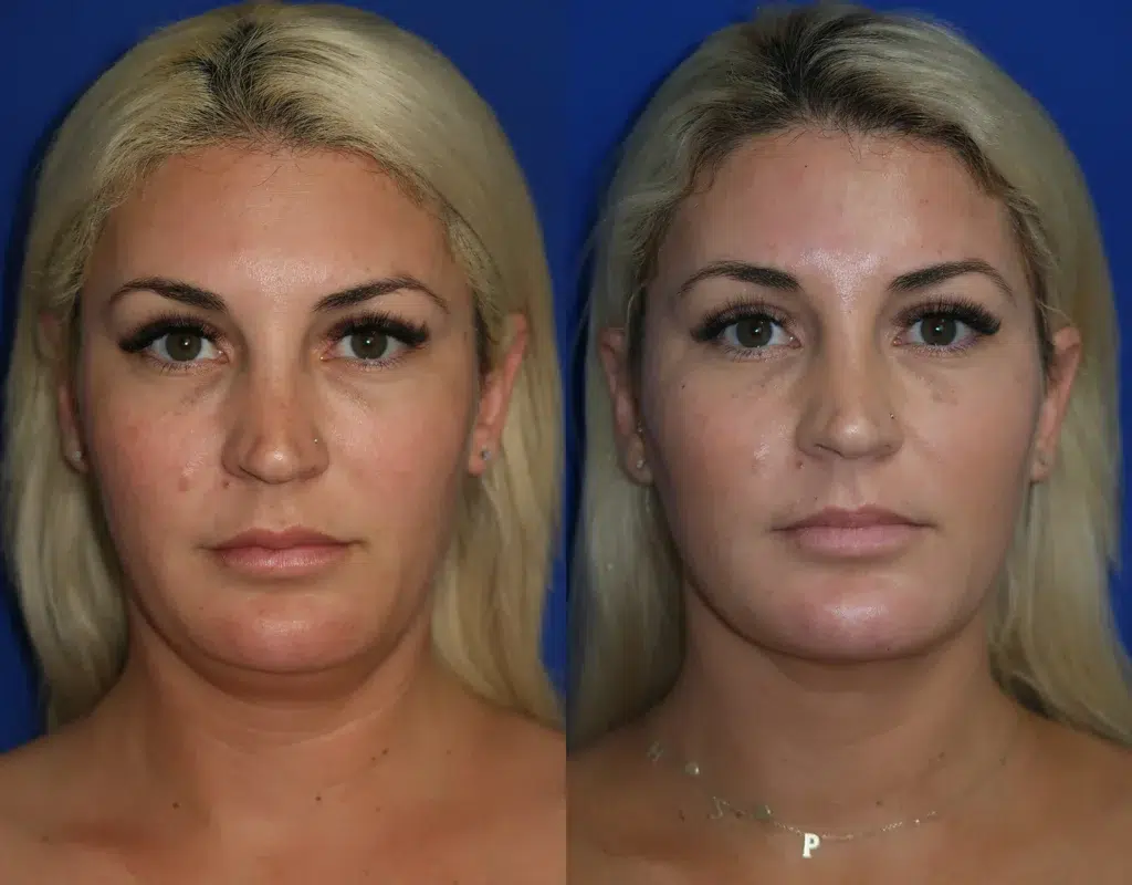 faceology lift neck Lift before and after photo by faceology md in newport beach ca
