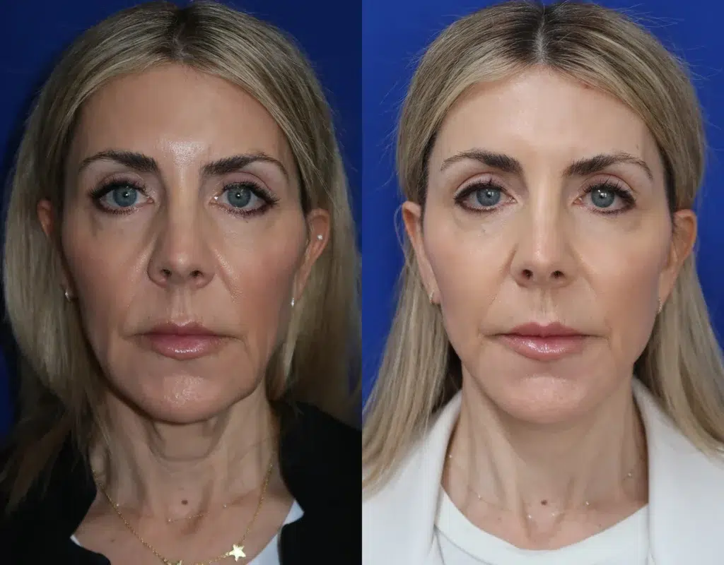 faceology lift neck Lift before and after photo by faceology md in newport beach ca