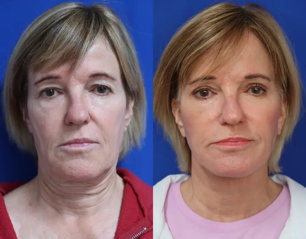 faceology lift neck lift with co laser before and after photo by faceology md in newport beach ca