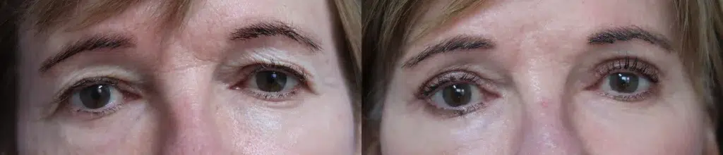 eyelid lift before and after photo by faceology md in newport beach ca