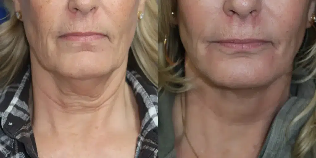 faceology lift neck lift before and after photo by faceology md in newport beach ca