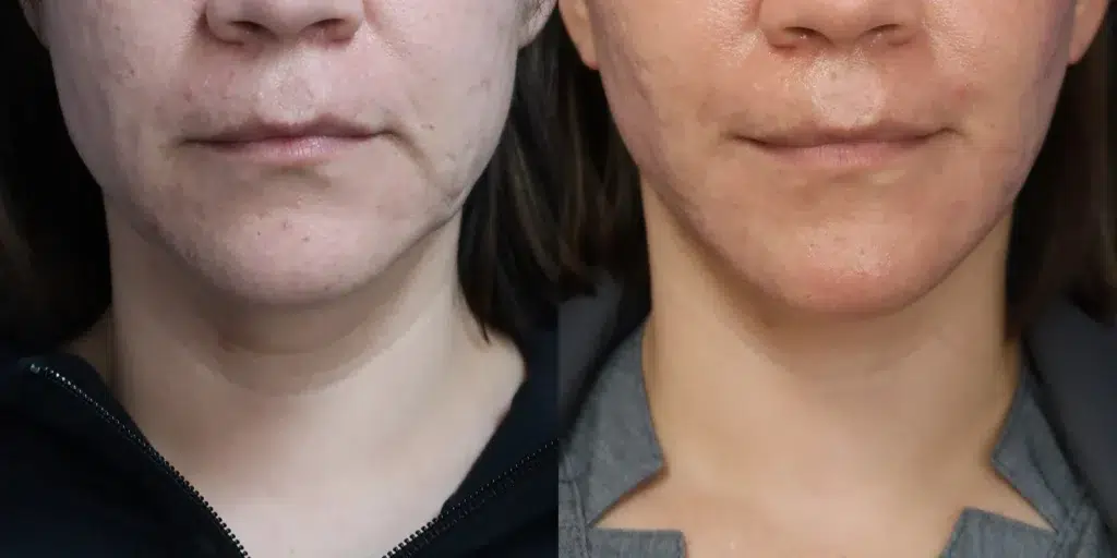 faceology lift neck lift before and after photo by faceology md in newport beach ca