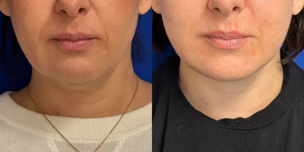 faceology lift neck lift before and after photo by faceology md in newport beach ca