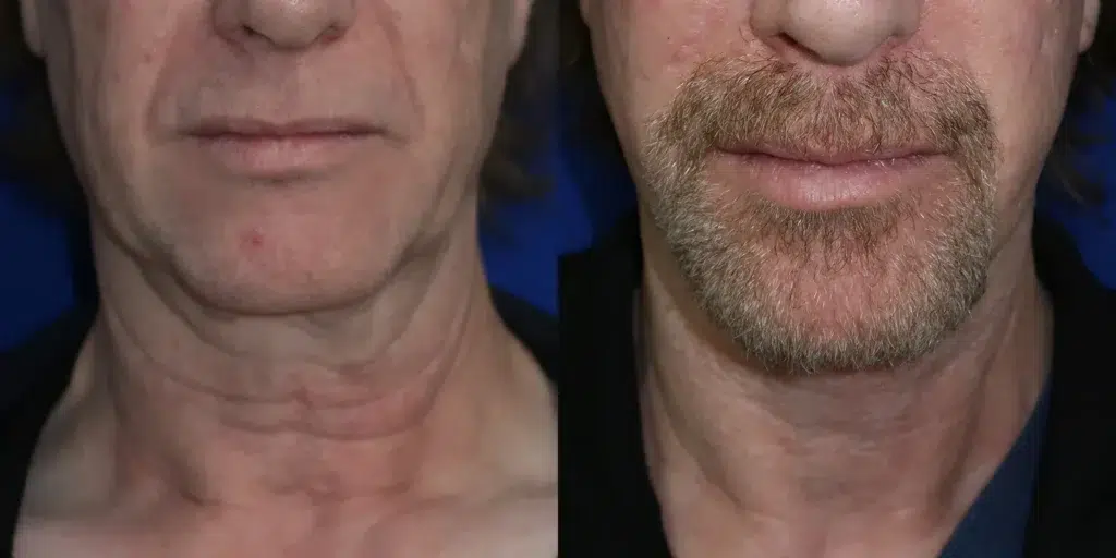 faceology lift neck lift before and after photo by faceology md in newport beach ca
