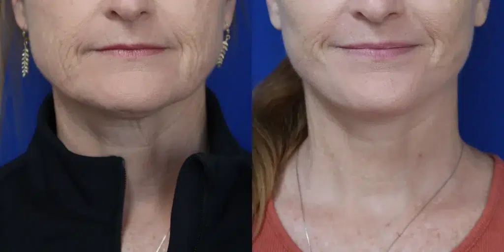 faceology lift neck lift before and after photo by faceology md in newport beach ca