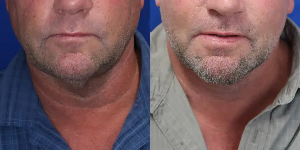 faceology lift neck lift before and after photo by faceology md in newport beach ca