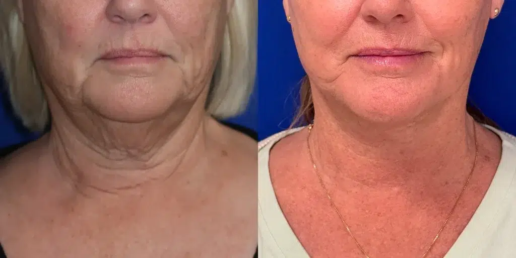 faceology lift neck lift before and after photo by faceology md in newport beach ca
