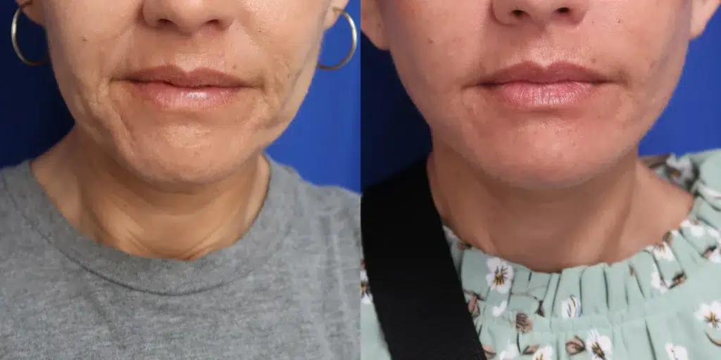 faceology lift neck lift before and after photo by faceology md in newport beach ca