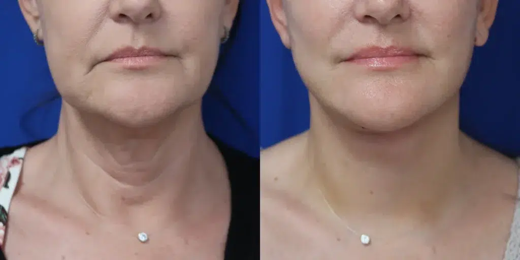 faceology lift neck lift before and after photo by faceology md in newport beach ca