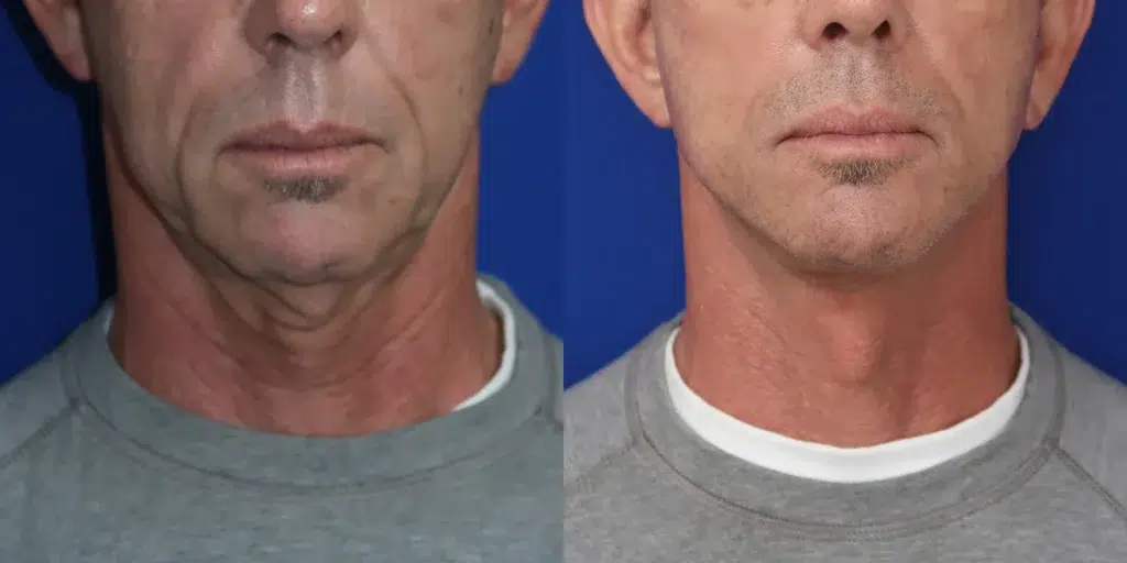 faceology lift neck lift before and after photo by faceology md in newport beach ca