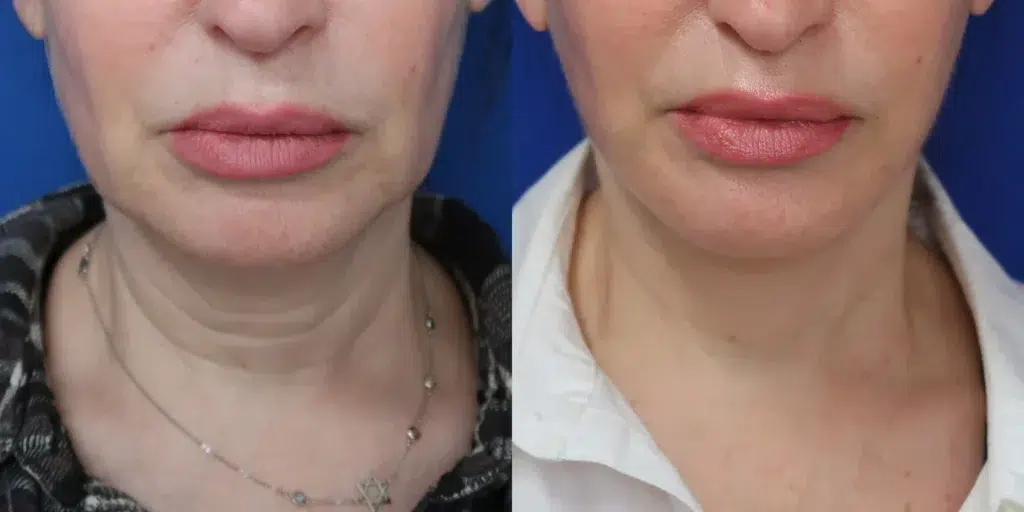 faceology lift neck lift before and after photo by faceology md in newport beach ca