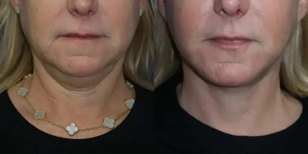 faceology lift neck lift before and after photo by faceology md in newport beach ca