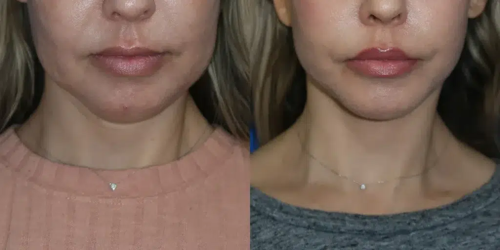 faceology lift neck lift before and after photo by faceology md in newport beach ca