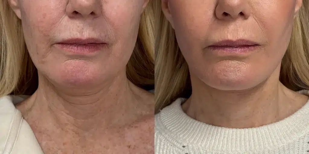 faceology lift neck lift before and after photo by faceology md in newport beach ca