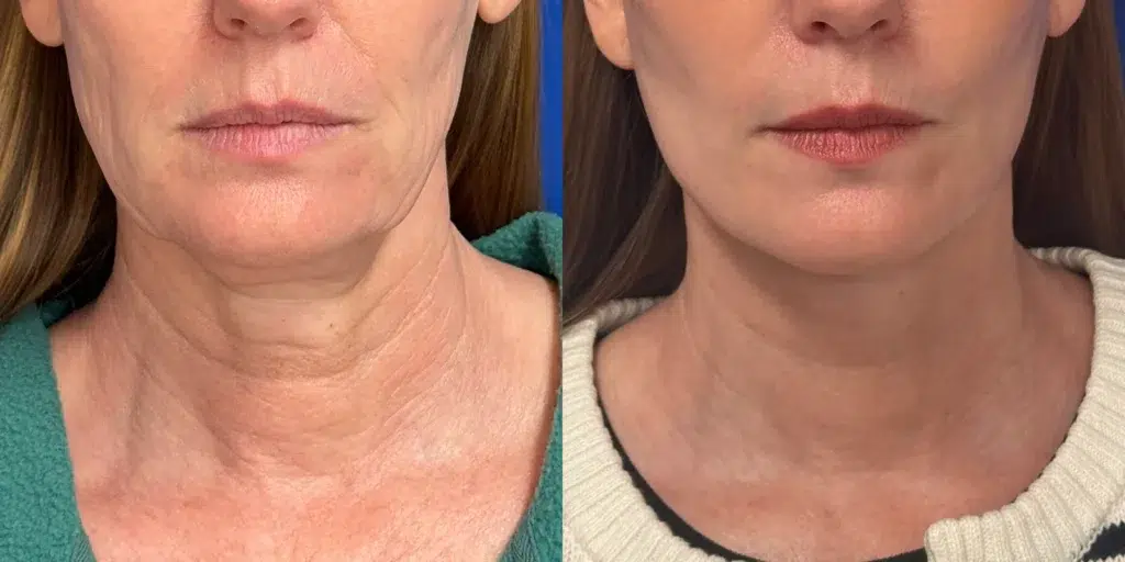 faceology lift neck lift before and after photo by faceology md in newport beach ca