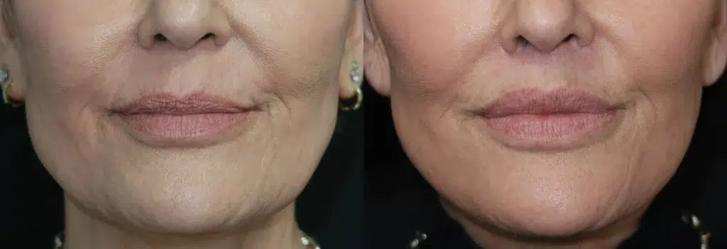 lip augmentation before and after photo by faceology md in newport beach ca