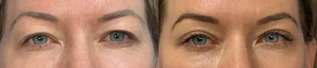 blepharoplasty with co2 before and after photo by faceology md in newport beach ca