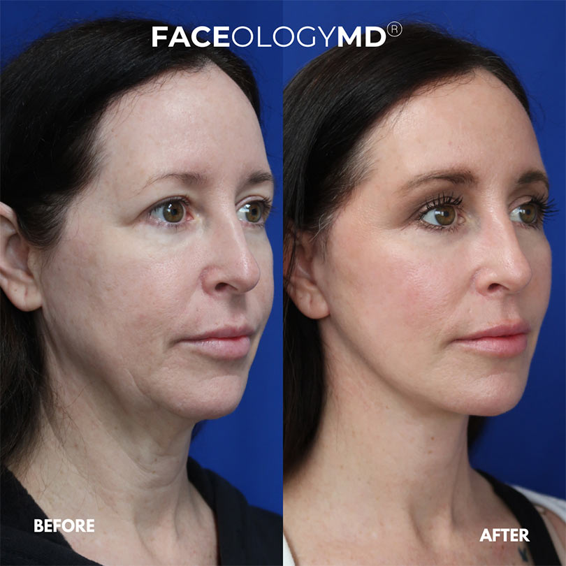 FACEOLOGY Before and After Skincare Instagram Post