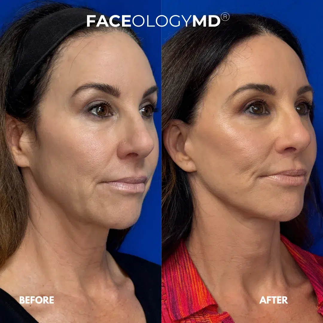 before and after facelift by faceology before and after facelift by faceology