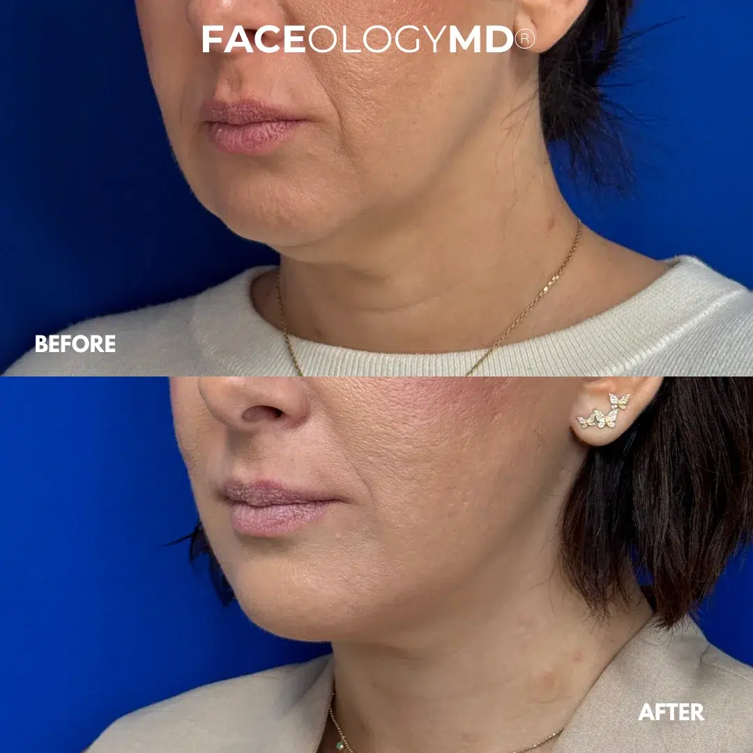 before and after facelift by faceology before and after facelift by faceology