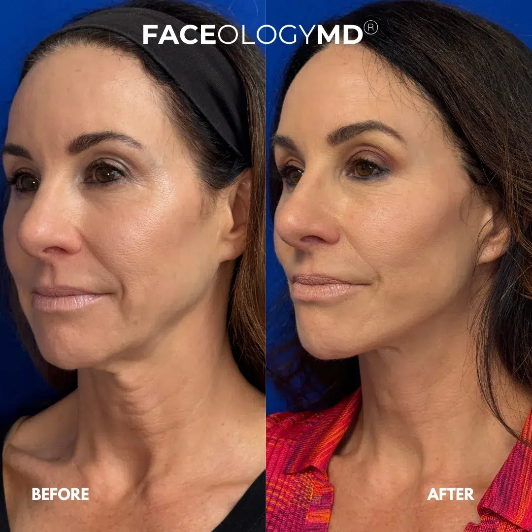 before and after facelift by faceology before and after facelift by faceology