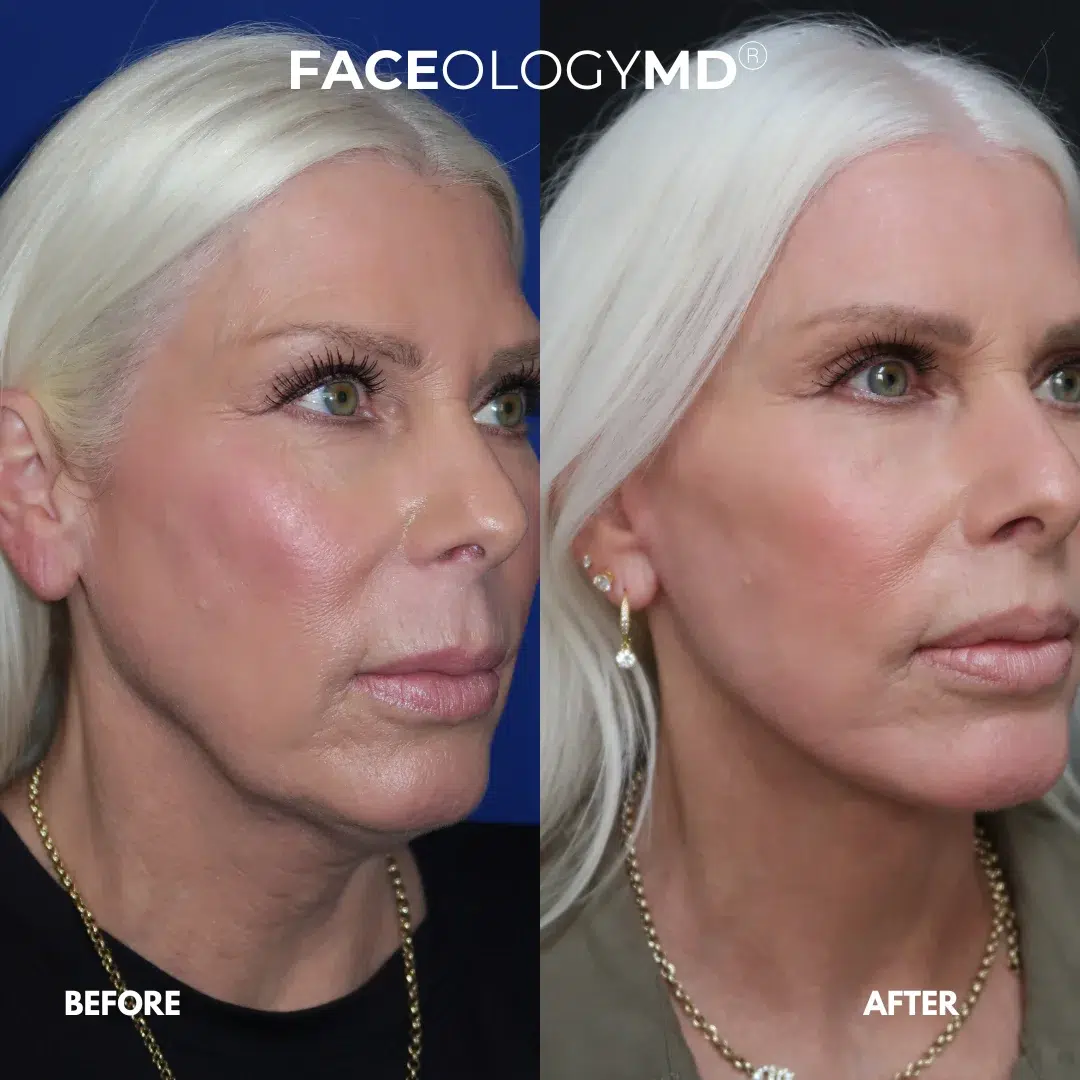 before and after facelift by faceology before and after facelift by faceology