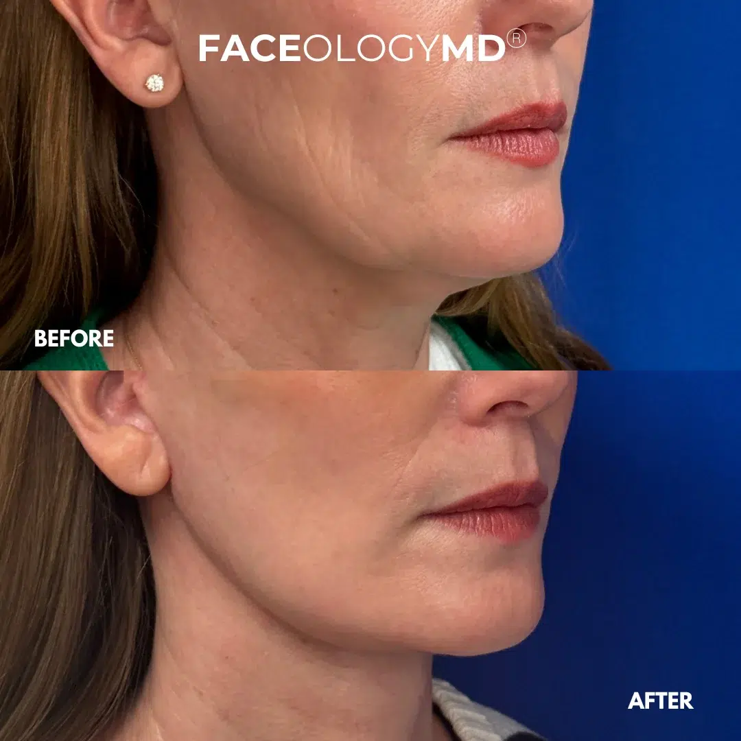 before and after facelift by faceology before and after facelift by faceology