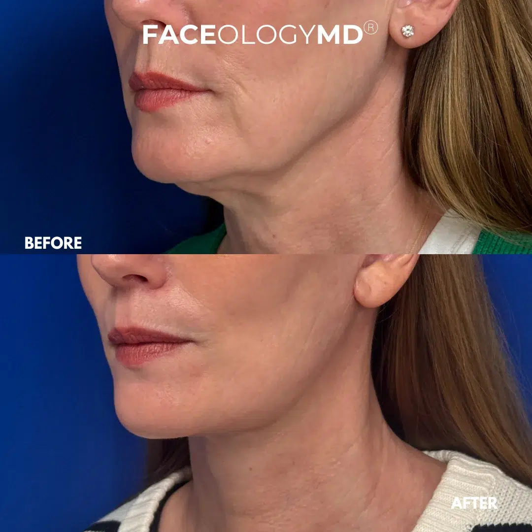 before and after facelift by faceology before and after facelift by faceology