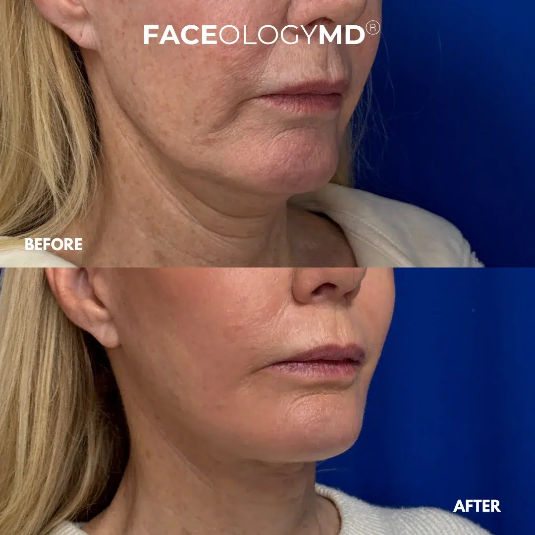 before and after facelift by faceology before and after facelift by faceology