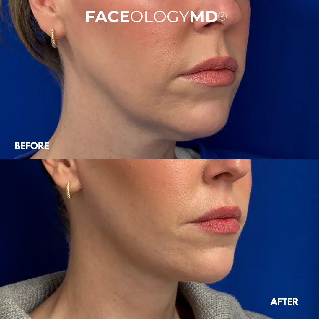 before and after facelift by faceology before and after facelift by faceology