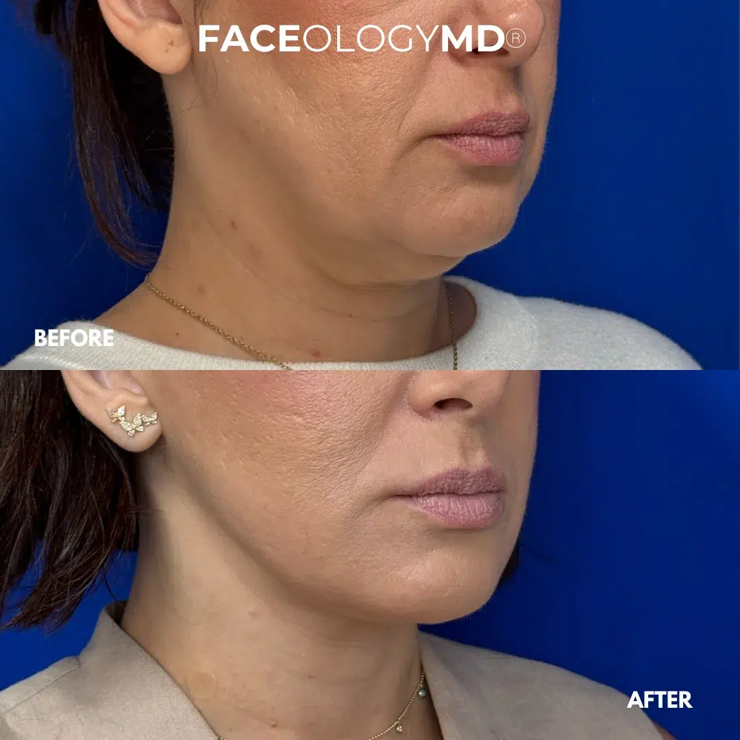 before and after facelift by faceology before and after facelift by faceology