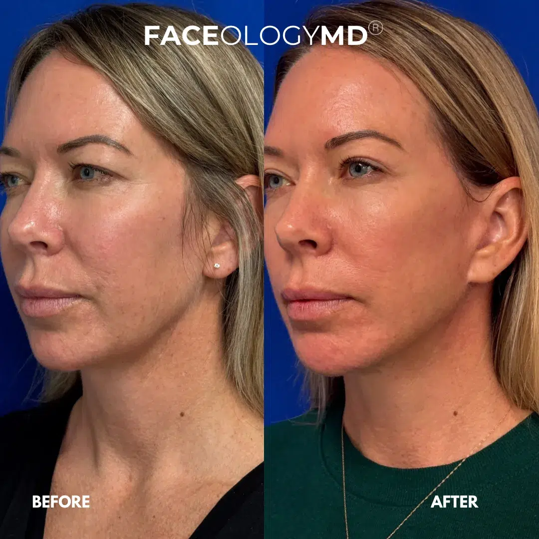 before and after facelift patient by faceology before and after facelift patient by faceology
