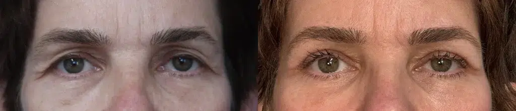 blepharoplasty before and after photo by faceology md in newport beach ca