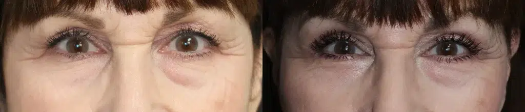 blepharoplasty before and after photo by faceology md in newport beach ca