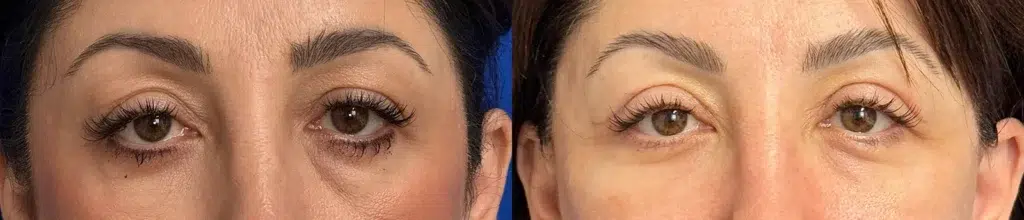 blepharoplasty before and after photo by faceology md in newport beach ca