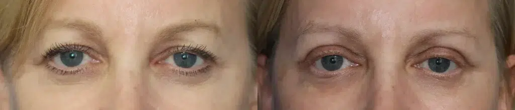 blepharoplasty before and after photo by faceology md in newport beach ca