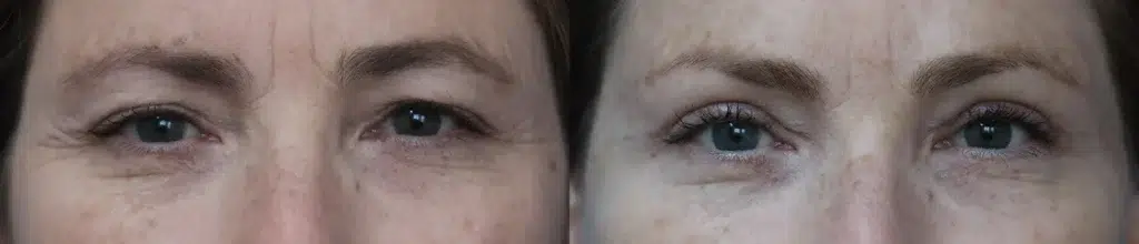 blepharoplasty before and after photo by faceology md in newport beach ca