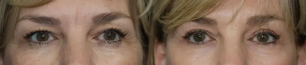 blepharoplasty before and after photo by faceology md in newport beach ca