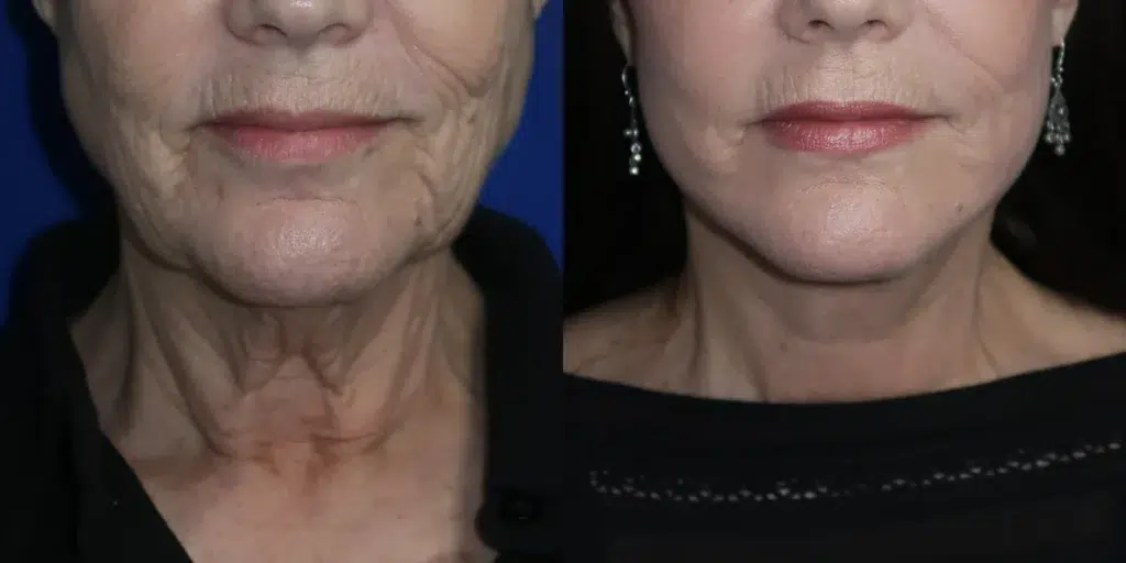 faceology lift neck lift before and after photo by faceology md in newport beach ca