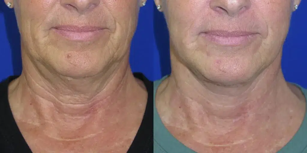 mini facelift before and after photo by faceology md in newport beach ca