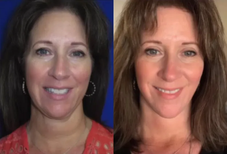 Front View CO Laser before and after by Faceology MD