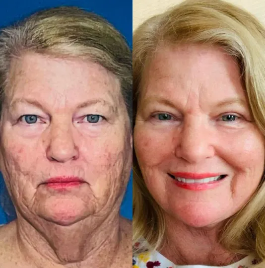 Front View CO Laser before and after by Faceology MD